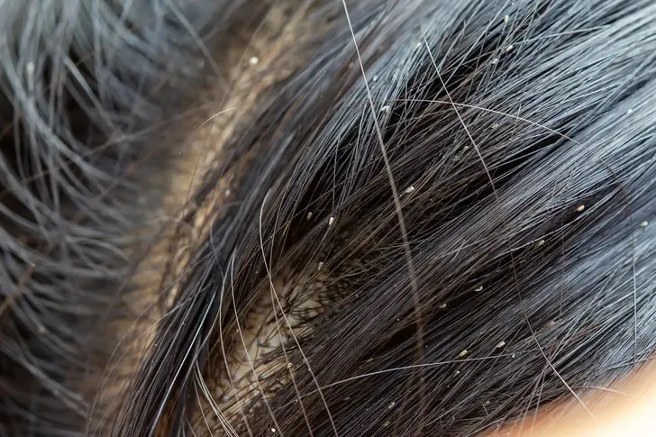 headlice